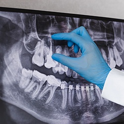 Dentist looking at patient's molar on X-ray