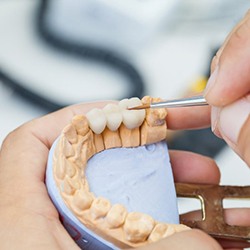 Dental bridge being crafted on model teeth