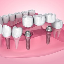 Illustration of implant bridge